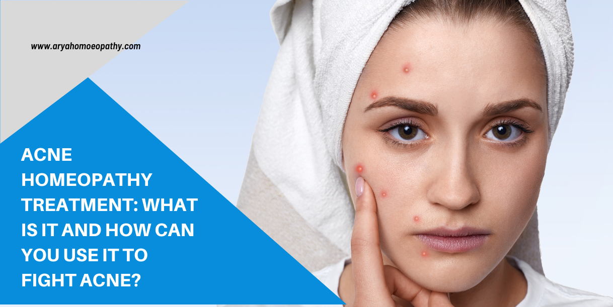 Acne Homeopathy Treatment: What Is It And How Can You Use It To Fight Acne?