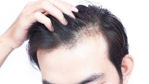 Navigating Hair Loss Solutions in Islamabad: A Comprehensive Guide
