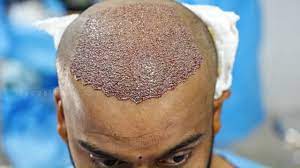 Embarking on a Transformational Odyssey: Discovering Hair Transplants in Islamabad